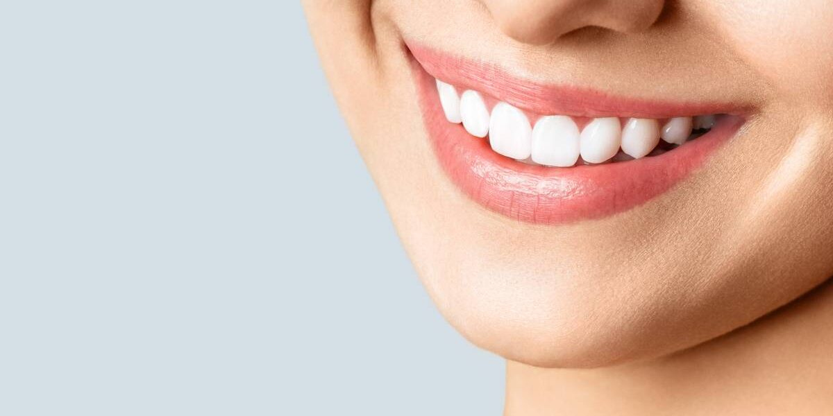 Cosa sono le faccette dentali A cosa servono e come vengono applicate  Orsini Dental Project